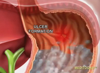 ulcerformation